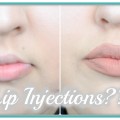 Lip-Injection-Fuller-Lips-Makeup-Monday